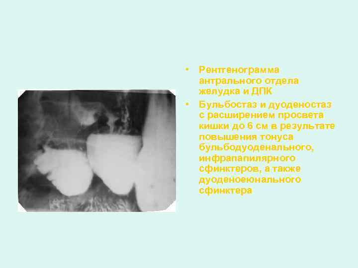  • Рентгенограмма антрального отдела желудка и ДПК • Бульбостаз и дуоденостаз с расширением