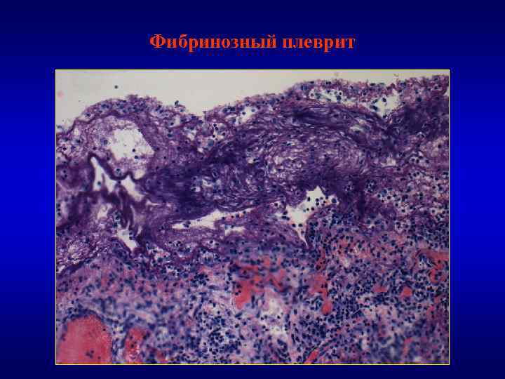 Фибринозный плеврит 