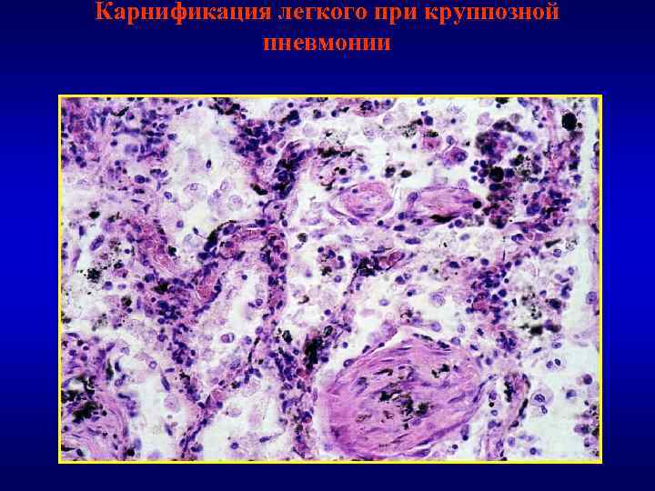 Карнификация легкого при круппозной пневмонии 