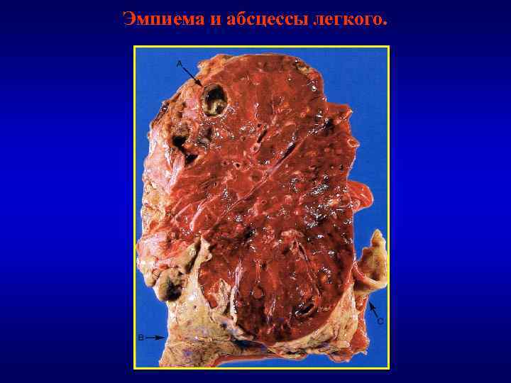 Эмпиема и абсцессы легкого. 