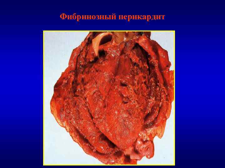 Фибринозный перикардит 