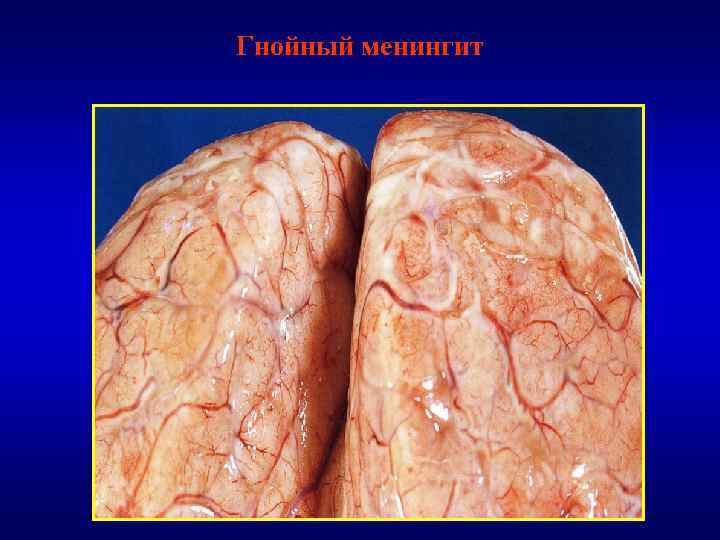 Гнойный менингит 