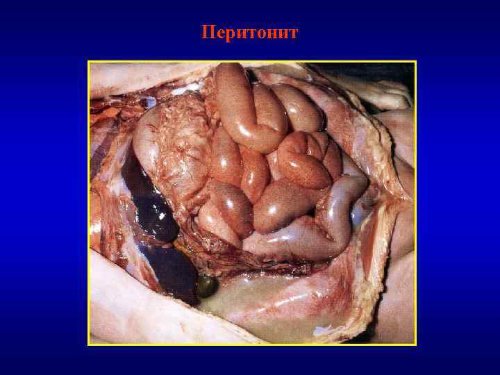 Перитонит 