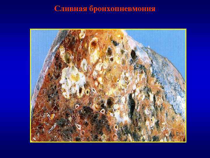 Сливная бронхопневмония 