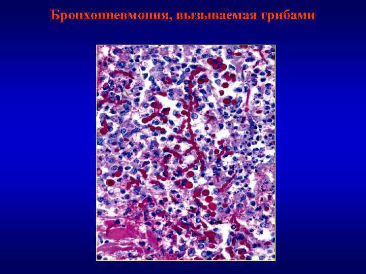 Бронхопневмония, вызываемая грибами 