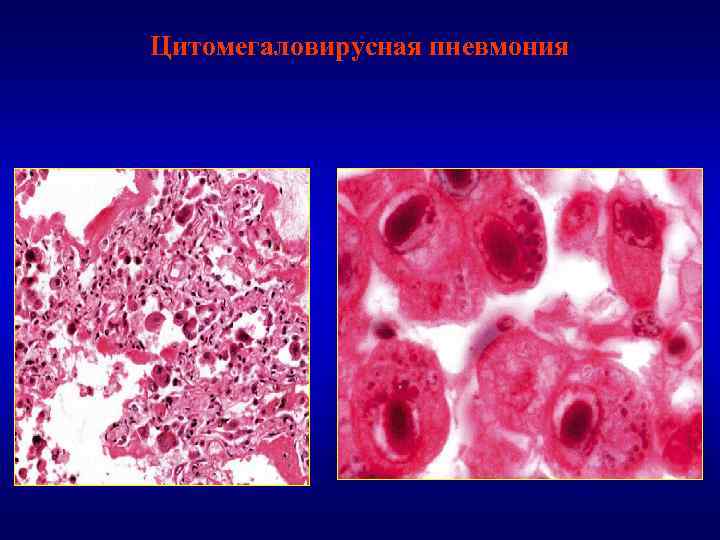 Цитомегаловирусная пневмония 
