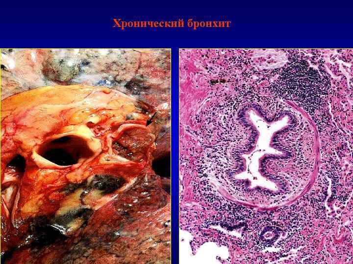 Хронический бронхит 