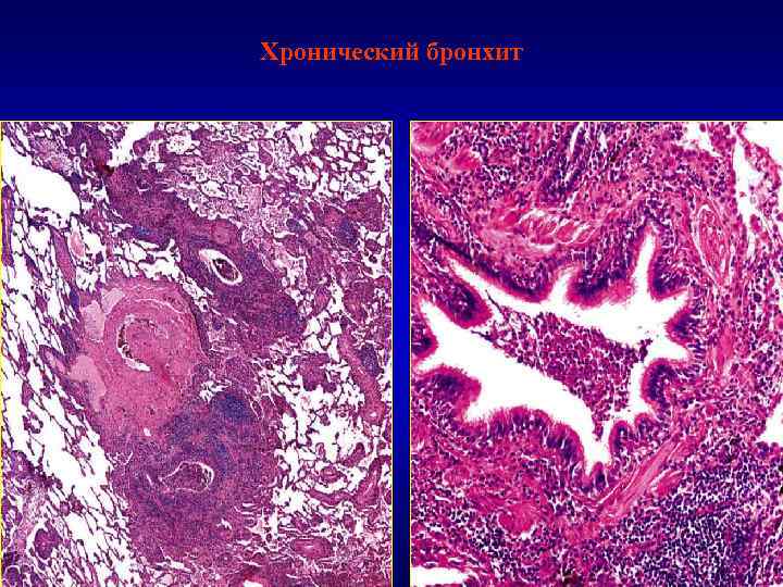 Хронический бронхит 