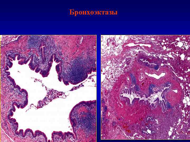 Назовите изменения в стенке бронха при бронхоэктазе