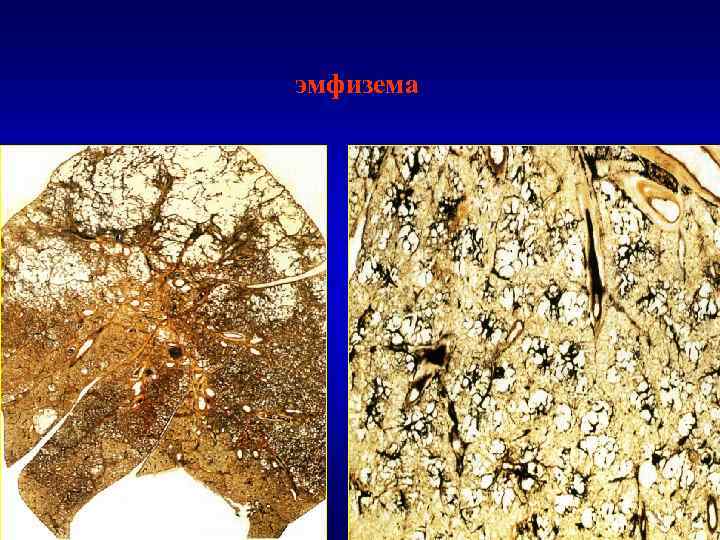 эмфизема 