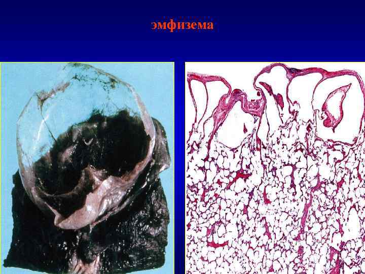 эмфизема 