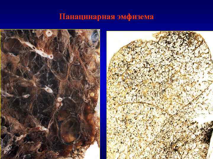Панацинарная эмфизема 
