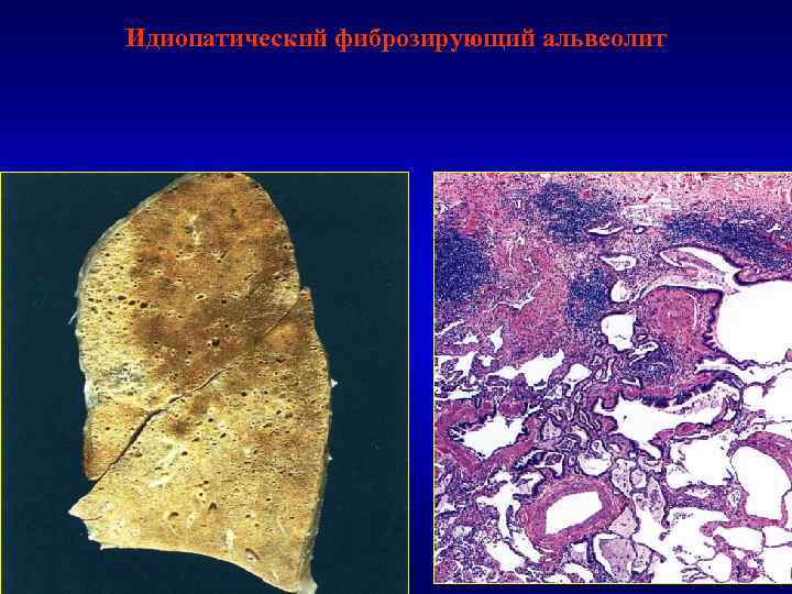 Идиопатический фиброзирующий альвеолит 