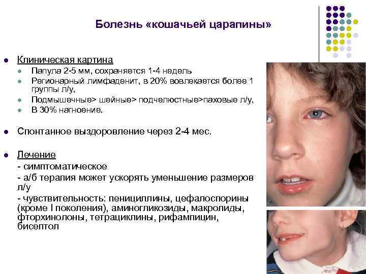 Болезнь «кошачьей царапины» l Клиническая картина l l Папула 2 -5 мм, сохраняется 1