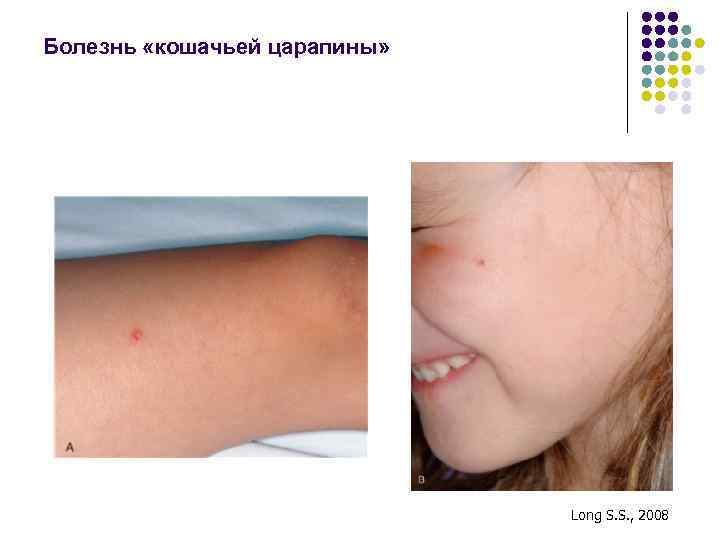 Болезнь «кошачьей царапины» Long S. S. , 2008 