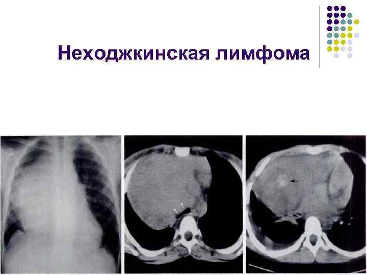 Неходжкинская лимфома 