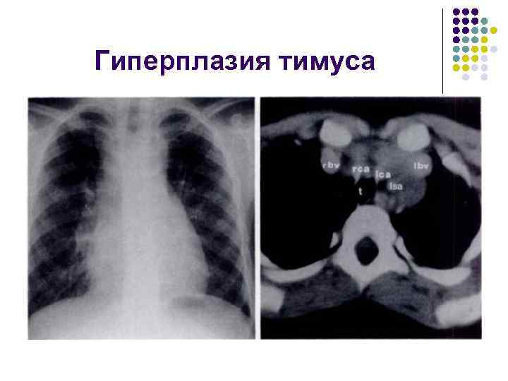 Гиперплазия тимуса 