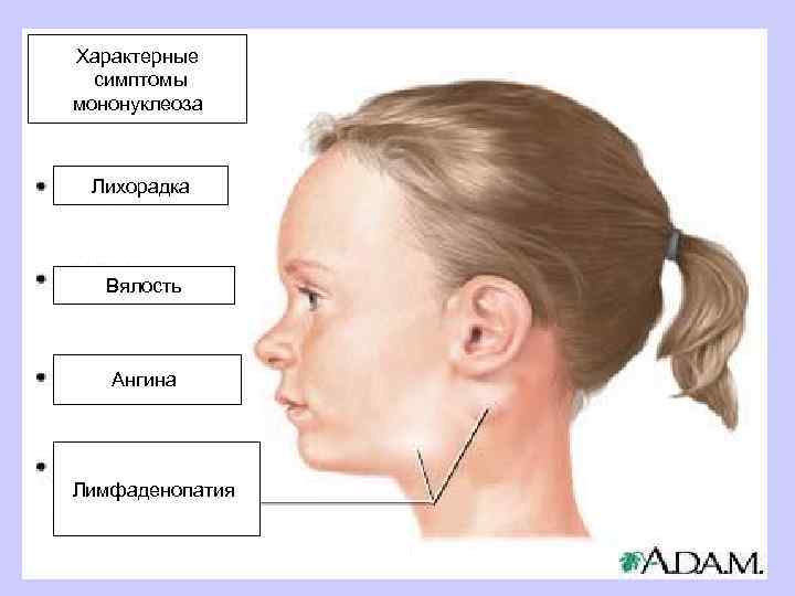 Характерные симптомы мононуклеоза Лихорадка Вялость Ангина Лимфаденопатия 