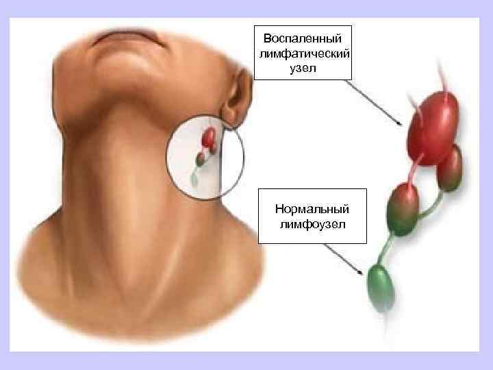 Воспаленный лимфатический узел Нормальный лимфоузел 