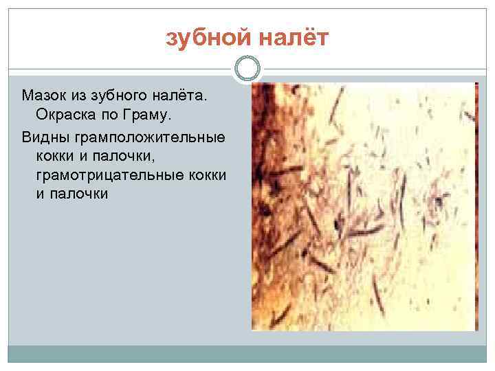 зубной налёт Мазок из зубного налёта. Окраска по Граму. Видны грамположительные кокки и палочки,