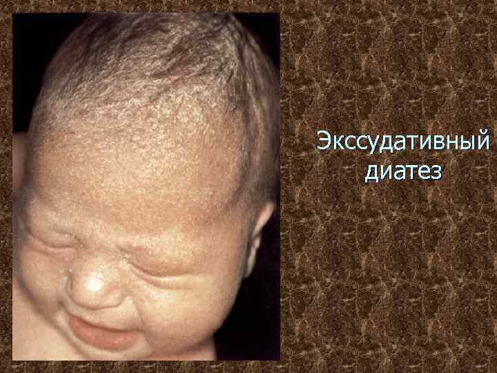 Экссудативный диатез 
