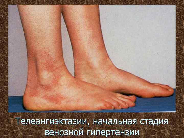Телеангиэктазии, начальная стадия венозной гипертензии 