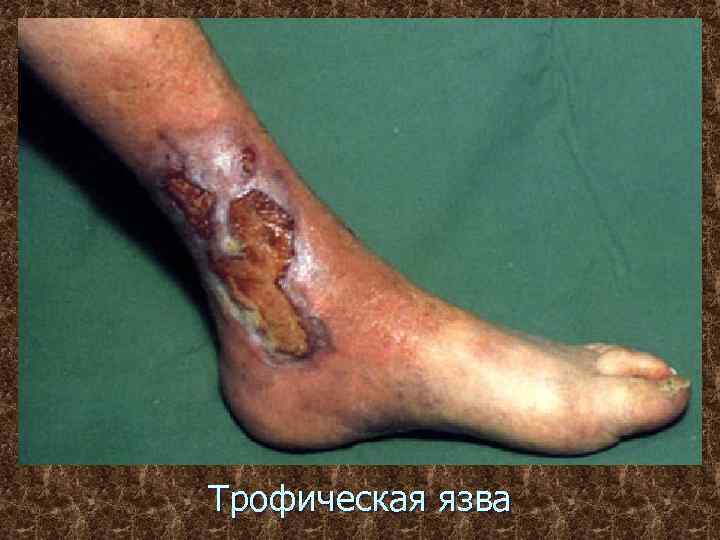 Трофическая язва 