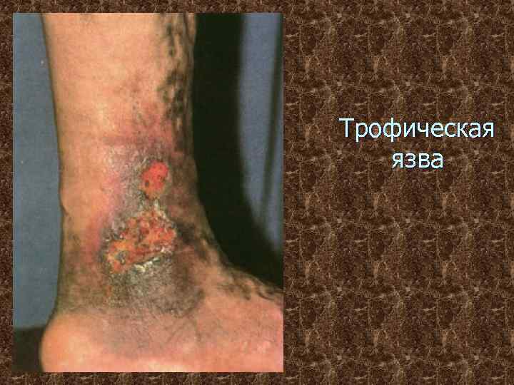 Трофическая язва 