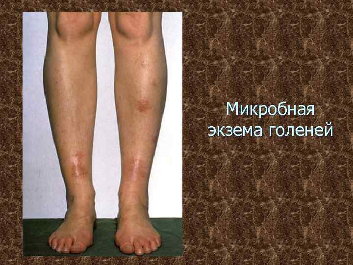 Микробная экзема голеней 