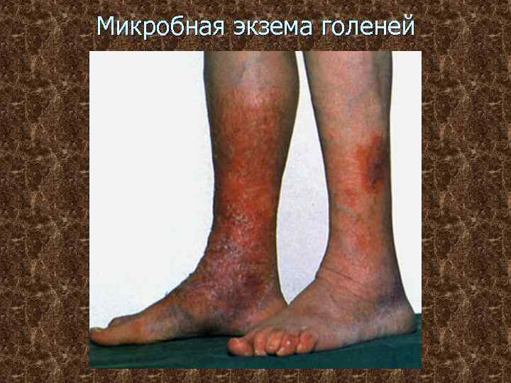 Микробная экзема голеней 