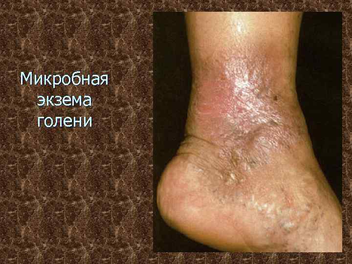 Микробная экзема голени 