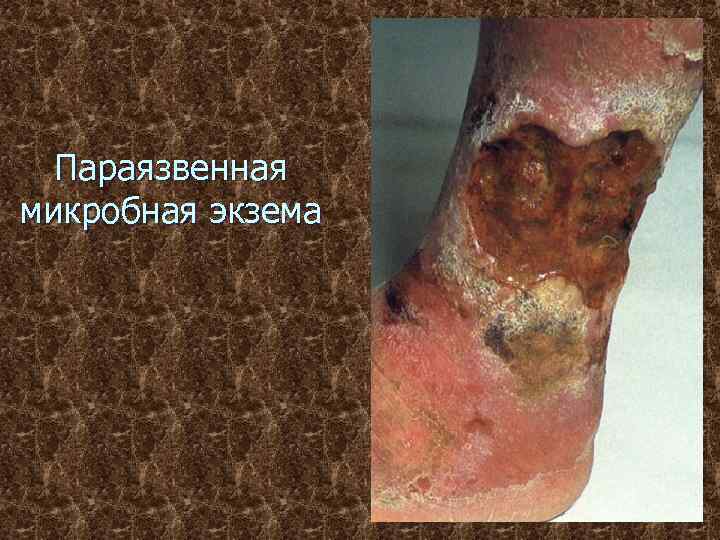 Параязвенная микробная экзема 