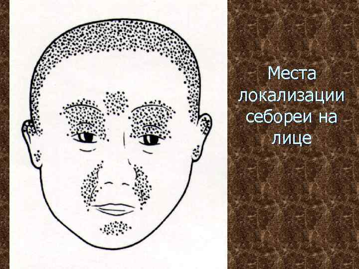 Места локализации себореи на лице 