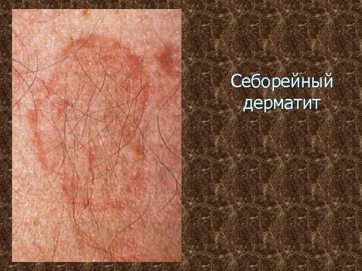 Себорейный дерматит 