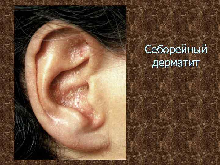 Себорейный дерматит 