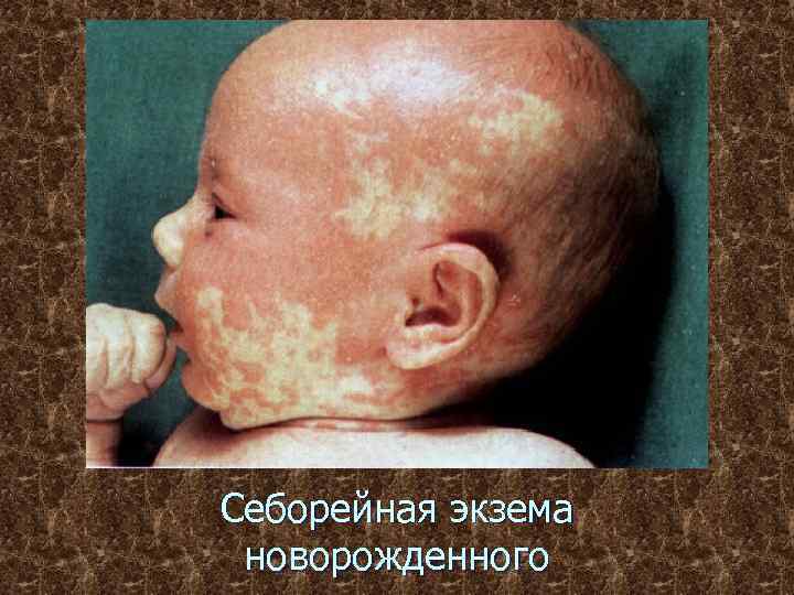 Себорейная экзема новорожденного 