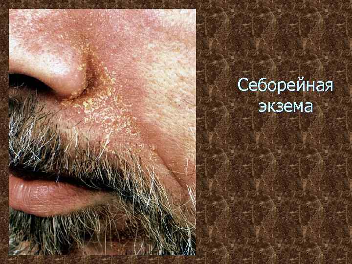 Себорейная экзема 