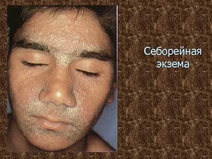 Себорейная экзема 