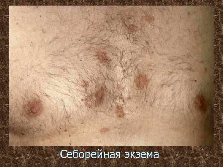 Себорейная экзема 