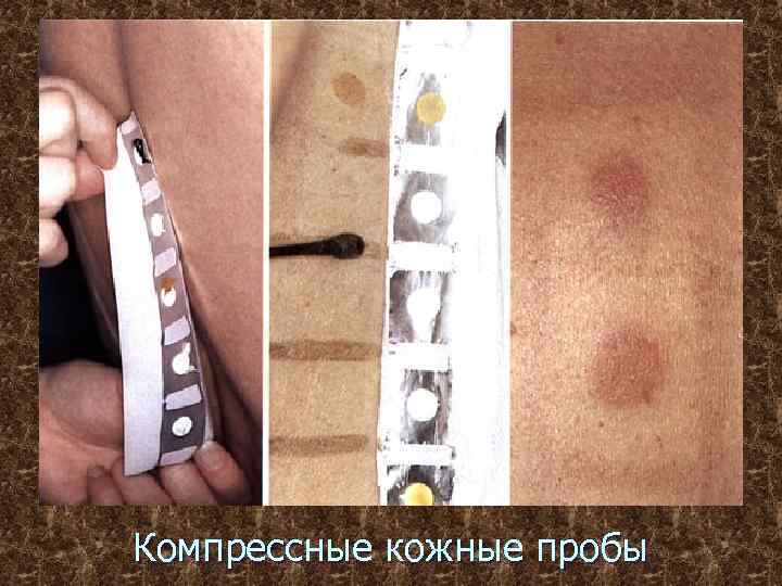 Компрессные кожные пробы 