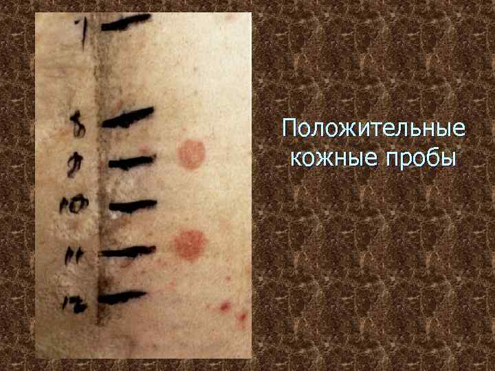 Положительные кожные пробы 