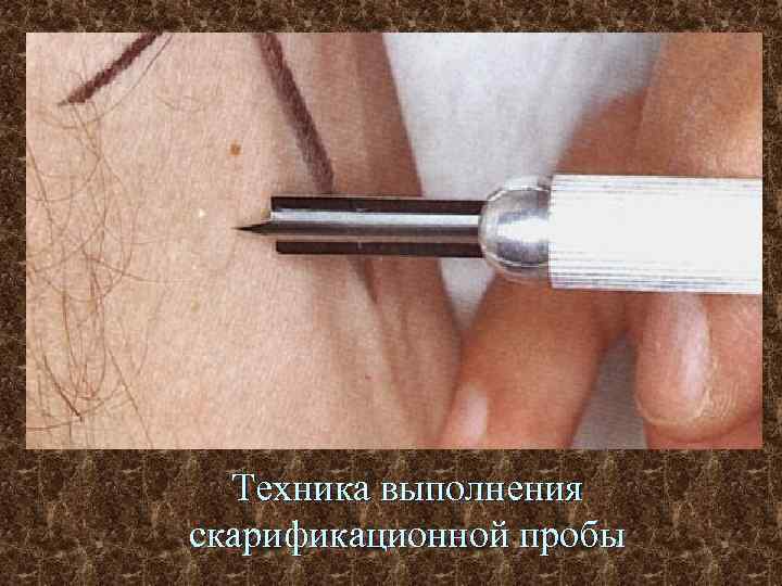 Техника выполнения скарификационной пробы 