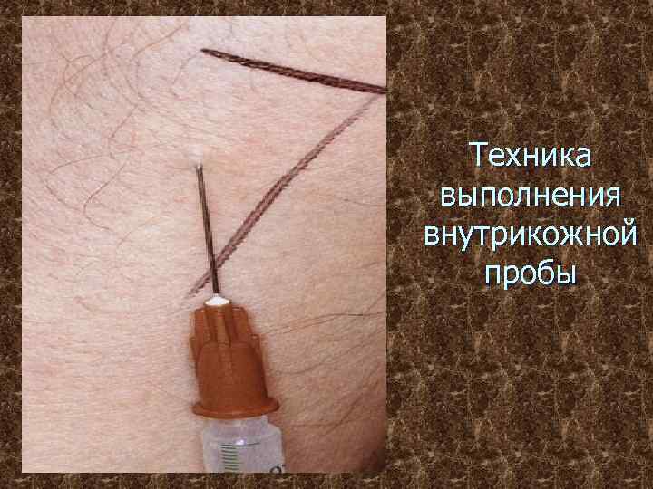 Техника выполнения внутрикожной пробы 