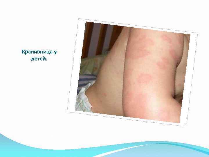 Крапивница у детей. 