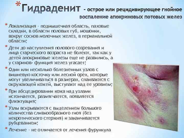 * * Локализация – подмышечная область, паховые складки, в области половых губ, мошонки, вокруг