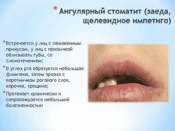 * * Встречается у лиц с заниженным прикусом, у лиц с привычкой облизывать губы,