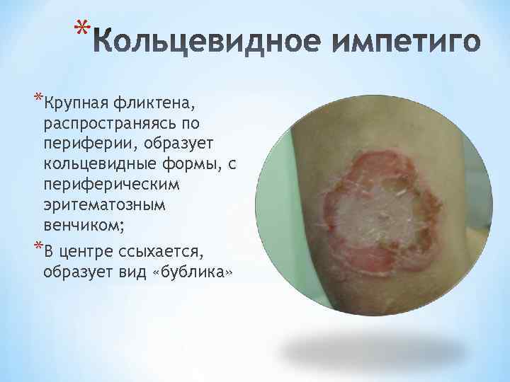 * *Крупная фликтена, распространяясь по периферии, образует кольцевидные формы, с периферическим эритематозным венчиком; *В