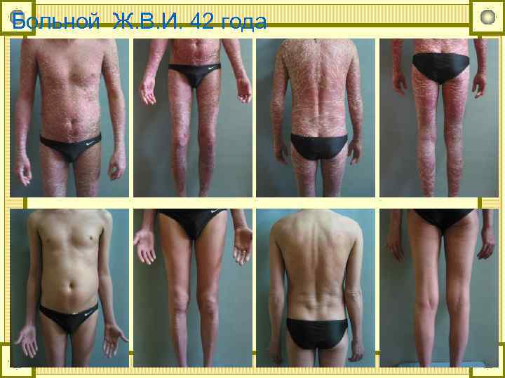 Больной Ж. В. И. 42 года 