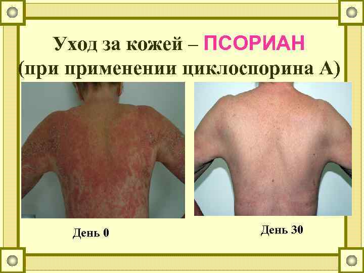 Уход за кожей – ПСОРИАН (при применении циклоспорина А) День 0 День 30 