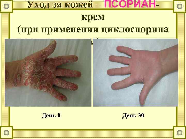 Уход за кожей – ПСОРИАНкрем (при применении циклоспорина А) День 0 День 30 